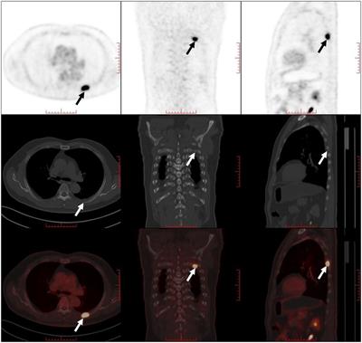 Diagnosis and treatment of isolated rib Langerhans cell histiocytosis in an adult: A case report